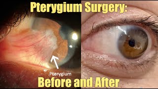 Ptergyium Surgery  Before and After What is it How we remove it Recovery and Results [upl. by Cirre22]