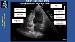 Wall Motion Abnormality Part II cases amp practice [upl. by Shalne]