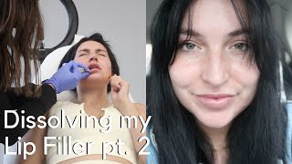 Dissolving Lip Fillers Before and after with hyaluronidase Vlog pt 2 [upl. by Ulphia]