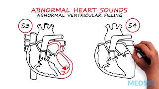 Abnormal Heartsounds and Murmurs Which heart sounds should worry you [upl. by Swayder241]