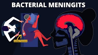 Bacterial Meningitis  Symptoms Diagnosis Treatments amp Pathology [upl. by Dorcea]