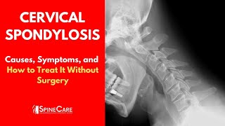 CERVICAL SPONDYLOSIS Causes Symptoms and Treatment NO SURGERY [upl. by Rotkiv]