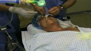 Fiberoptic Intubation [upl. by Ferrand]