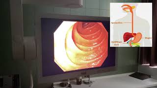MediMittwoch 8 Magenspiegelung Gastroskopie [upl. by Adnahsor]