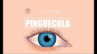 Pinguecula Causes Treatments and Prevention [upl. by Mauricio]