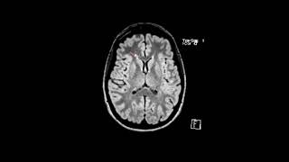 MS white matter lesions  First Look MRI [upl. by Ydisahc]