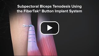 Subpectoral Biceps Tenodesis Using the FiberTak® Button Implant System [upl. by Nnylyar488]