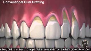 No Cutting Gum Graft with Pinhole Surgical Procedure [upl. by Lazor]