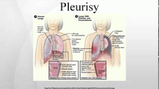 Pleurisy [upl. by Winchester]