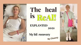 Explant Journey 2021 BII  Breast implant illness Capsulectomy My breast Implants made me SICK [upl. by Shien]