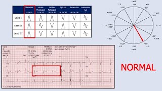 Cardiac Axis Determination [upl. by Mcquoid]