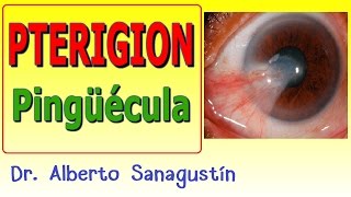 PTERIGION y PINGUÉCULA ocular [upl. by Selig]