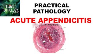 ACUTE APPENDICITIS Etiopathogenesis clinical features amp morphology [upl. by Agemo]