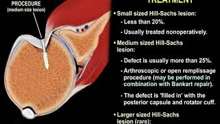 Shoulder Dislocation amp Hill Sachs Injury  Everything You Need To Know  Dr Nabil Ebraheim [upl. by Leo]