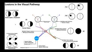 Lesions to the Visual Pathway EXPLAINED [upl. by Mcarthur]