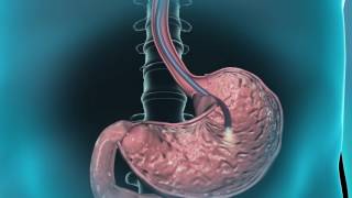 Learn about gastroscopy [upl. by Brookhouse]