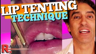 LIP FILLER RUSSIAN TENTING TECHNIQUE Demonstrated  Lip Filler Before and After [upl. by Raveaux975]