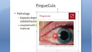 Ophthalmology 095 a PinGueCula What is Eye growth Yellow Degenerative Conjunctiva Reason Etiology [upl. by Helbonnas]