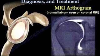 SLAP Tear Symptoms Diagnosis And Treatment  Everything You Need To Know  Dr Nabil Ebraheim [upl. by Eirlav836]