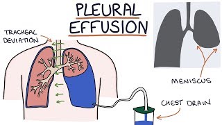 Understanding Pleural Effusions [upl. by Mercuri628]