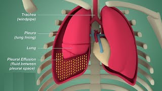 Pleural effusion  Internal medicine Etiology Clinical Features Diagnosis and Treatment Usmle [upl. by Anomas]