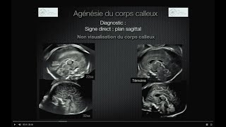 MALFORMATIONS CEREBRALES EN ECHOGRAPHIE OBSTETRICALE [upl. by Devland]