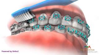 Life with Braces  Brushing amp Flossing [upl. by Eirollam]