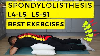 Spondylolisthesis treatment [upl. by Ettena119]