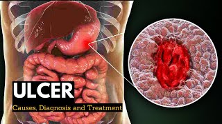 Ulcer Causes Signs and Symptoms Diagnosis and Treatment [upl. by Blackmun]