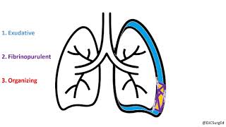 Empyema and Pleural Effusions [upl. by Rehnberg430]