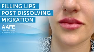 Filling Noras Lips Five Weeks Post Dissolving Migrated Filler  AAFE [upl. by Renraw]